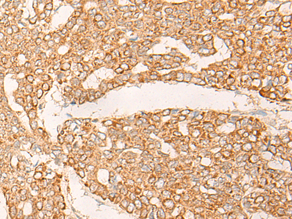 Immunohistochemistry of paraffin-embedded Human liver cancer tissue  using KRT9 Polyclonal Antibody at dilution of 1:30(×200)