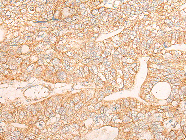 Immunohistochemistry of paraffin-embedded Human gastric cancer tissue  using KRT9 Polyclonal Antibody at dilution of 1:30(×200)