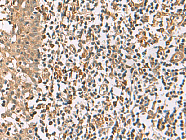 Immunohistochemistry of paraffin-embedded Human tonsil tissue  using DCAF12 Polyclonal Antibody at dilution of 1:65(×200)