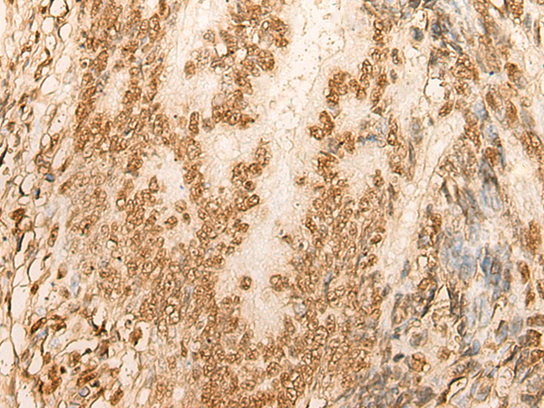 Immunohistochemistry of paraffin-embedded Human colorectal cancer tissue  using HIST1H2BA Polyclonal Antibody at dilution of 1:45(×200)