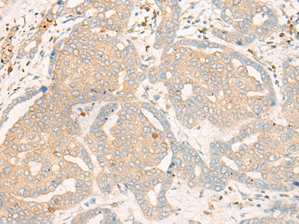 Immunohistochemistry of paraffin-embedded Human liver cancer tissue  using FBXO32 Polyclonal Antibody at dilution of 1:35(×200)