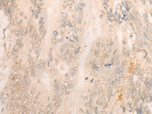 Immunohistochemistry of paraffin-embedded Human colorectal cancer tissue  using FBXO32 Polyclonal Antibody at dilution of 1:35(×200)