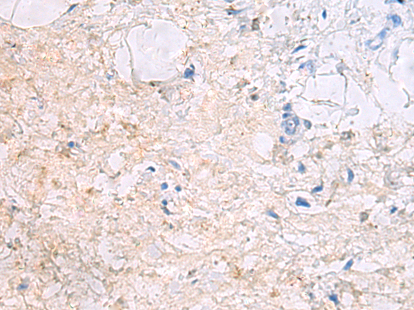 Immunohistochemistry of paraffin-embedded Human gastric cancer tissue  using DPCD Polyclonal Antibody at dilution of 1:50(×200)