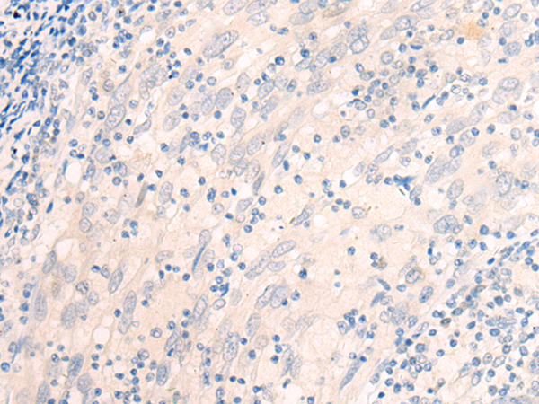 Immunohistochemistry of paraffin-embedded Human cervical cancer tissue  using EME2 Polyclonal Antibody at dilution of 1:40(×200)
