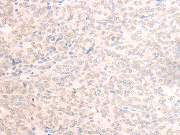 Immunohistochemistry of paraffin-embedded Human ovarian cancer tissue  using EME2 Polyclonal Antibody at dilution of 1:40(×200)