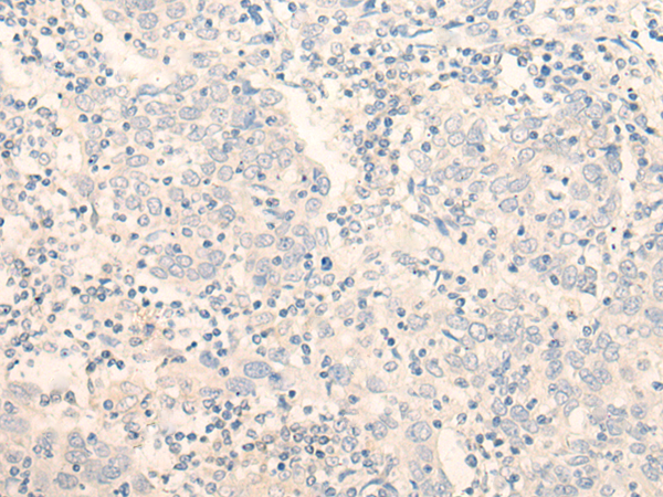 Immunohistochemistry of paraffin-embedded Human cervical cancer tissue  using ADGRE3 Polyclonal Antibody at dilution of 1:35(×200)