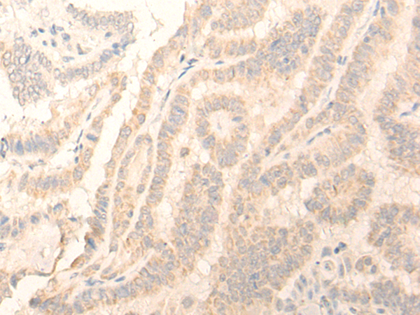 Immunohistochemistry of paraffin-embedded Human thyroid cancer tissue  using ADGRE3 Polyclonal Antibody at dilution of 1:35(×200)