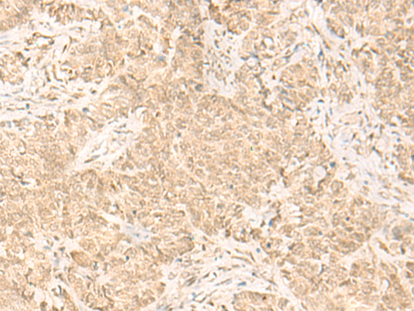 Immunohistochemistry of paraffin-embedded Human ovarian cancer tissue  using IL32 Polyclonal Antibody at dilution of 1:45(×200)