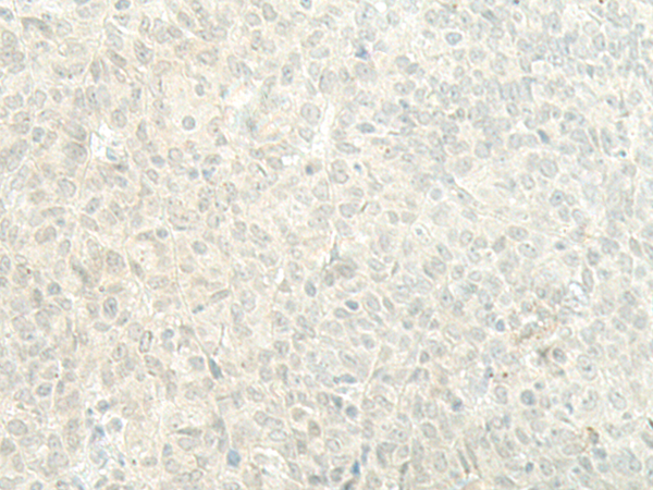 Immunohistochemistry of paraffin-embedded Human ovarian cancer tissue  using ESRP2 Polyclonal Antibody at dilution of 1:95(×200)