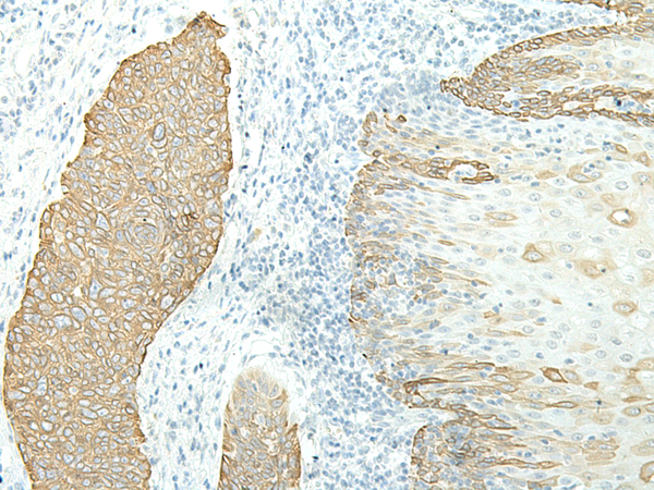 Immunohistochemistry of paraffin-embedded Human esophagus cancer tissue  using ETAA1 Polyclonal Antibody at dilution of 1:40(×200)