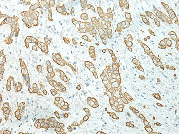 Immunohistochemistry of paraffin-embedded Human breast cancer tissue  using ETAA1 Polyclonal Antibody at dilution of 1:40(×200)