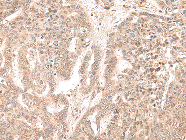 Immunohistochemistry of paraffin-embedded Human liver cancer tissue  using EXOSC9 Polyclonal Antibody at dilution of 1:35(×200)