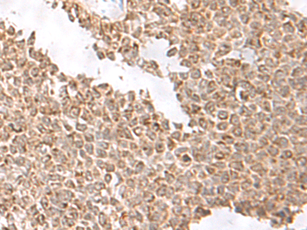 Immunohistochemistry of paraffin-embedded Human ovarian cancer tissue  using USP16 Polyclonal Antibody at dilution of 1:75(×200)
