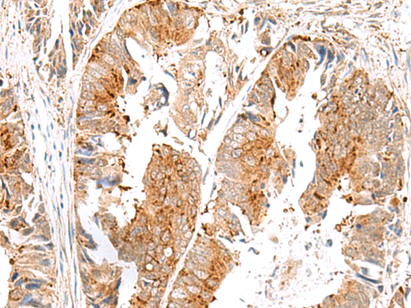 Immunohistochemistry of paraffin-embedded Human colorectal cancer tissue  using SAXO2 Polyclonal Antibody at dilution of 1:45(×200)