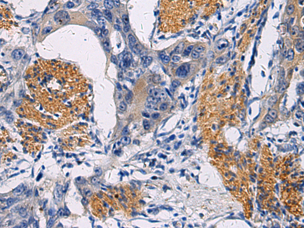 Immunohistochemistry of paraffin-embedded Human esophagus cancer tissue  using FAM20C Polyclonal Antibody at dilution of 1:45(×200)