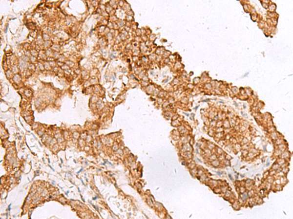 Immunohistochemistry of paraffin-embedded Human thyroid cancer tissue  using FAM200A Polyclonal Antibody at dilution of 1:45(×200)