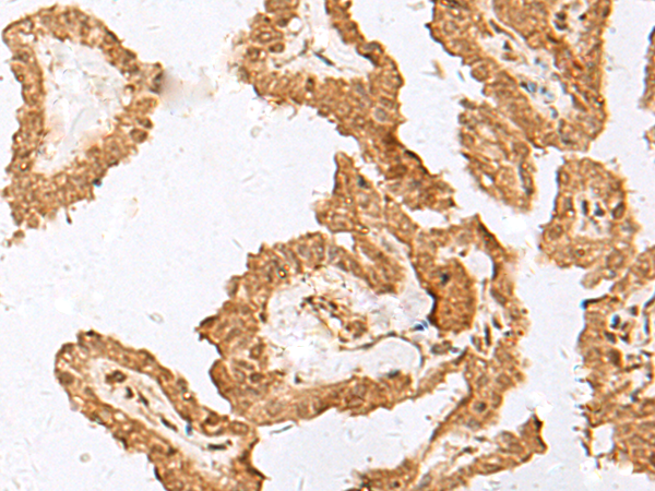 Immunohistochemistry of paraffin-embedded Human thyroid cancer tissue  using FAM84A Polyclonal Antibody at dilution of 1:35(×200)