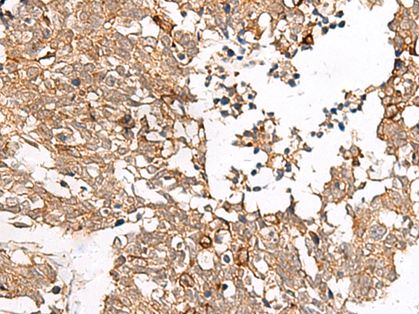 Immunohistochemistry of paraffin-embedded Human lung cancer tissue  using FAM84B Polyclonal Antibody at dilution of 1:45(×200)