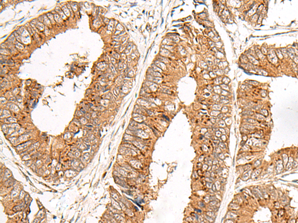 Immunohistochemistry of paraffin-embedded Human colorectal cancer tissue  using FAM84B Polyclonal Antibody at dilution of 1:45(×200)