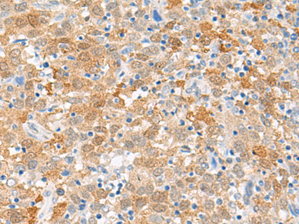 Immunohistochemistry of paraffin-embedded Human cervical cancer tissue  using FANCB Polyclonal Antibody at dilution of 1:60(×200)