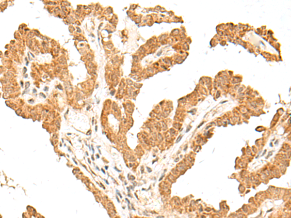 Immunohistochemistry of paraffin-embedded Human thyroid cancer tissue  using FANCB Polyclonal Antibody at dilution of 1:60(×200)