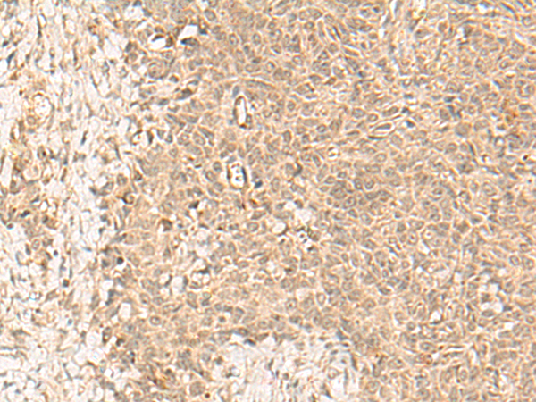 Immunohistochemistry of paraffin-embedded Human ovarian cancer tissue  using FBXL4 Polyclonal Antibody at dilution of 1:25(×200)