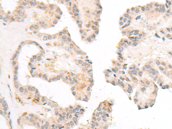 Immunohistochemistry of paraffin-embedded Human thyroid cancer tissue  using FBXW8 Polyclonal Antibody at dilution of 1:70(×200)