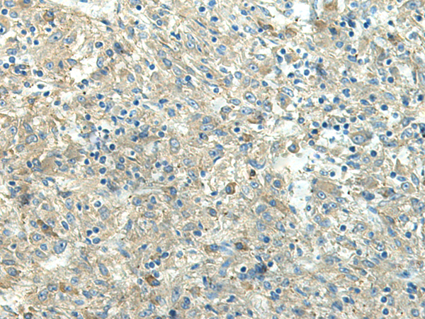 Immunohistochemistry of paraffin-embedded Human liver cancer tissue  using FCGRT Polyclonal Antibody at dilution of 1:65(×200)