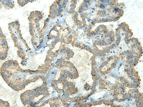 Immunohistochemistry of paraffin-embedded Human thyroid cancer tissue  using FCGRT Polyclonal Antibody at dilution of 1:65(×200)