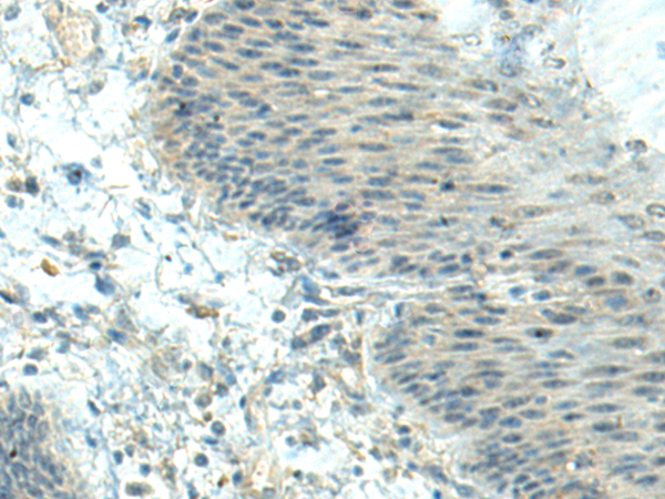 Immunohistochemistry of paraffin-embedded Human esophagus cancer tissue  using CTDP1 Polyclonal Antibody at dilution of 1:70(×200)