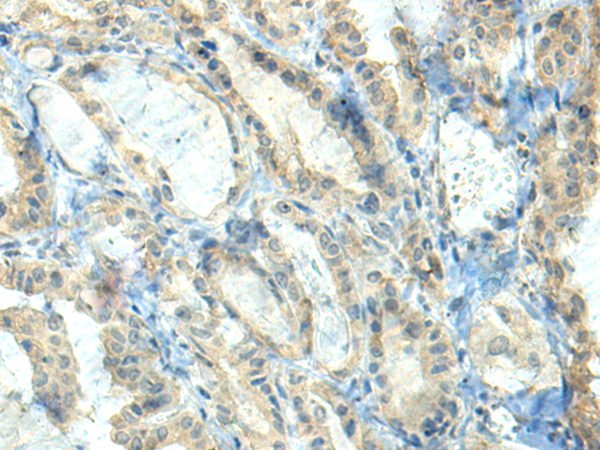 Immunohistochemistry of paraffin-embedded Human thyroid cancer tissue  using CTDP1 Polyclonal Antibody at dilution of 1:70(×200)