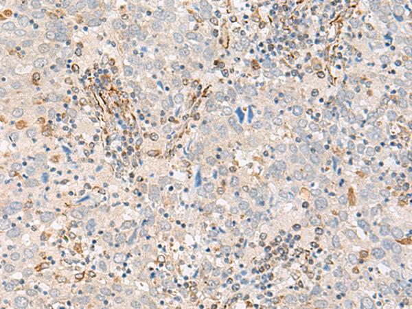 Immunohistochemistry of paraffin-embedded Human cervical cancer tissue  using FECH Polyclonal Antibody at dilution of 1:55(×200)