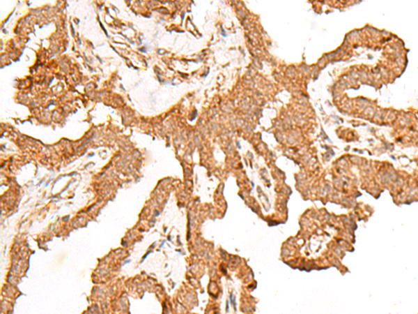Immunohistochemistry of paraffin-embedded Human thyroid cancer tissue  using FER Polyclonal Antibody at dilution of 1:80(×200)