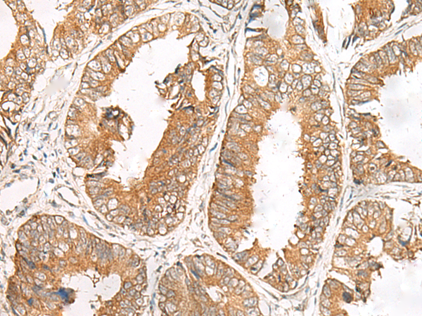 Immunohistochemistry of paraffin-embedded Human colorectal cancer tissue  using FERD3L Polyclonal Antibody at dilution of 1:85(×200)