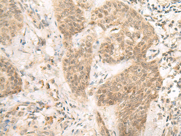 Immunohistochemistry of paraffin-embedded Human esophagus cancer tissue  using FERD3L Polyclonal Antibody at dilution of 1:85(×200)