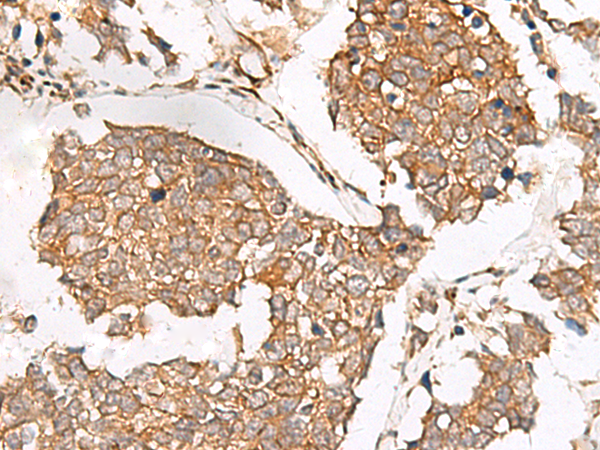 Immunohistochemistry of paraffin-embedded Human lung cancer tissue  using SLC40A1 Polyclonal Antibody at dilution of 1:65(×200)