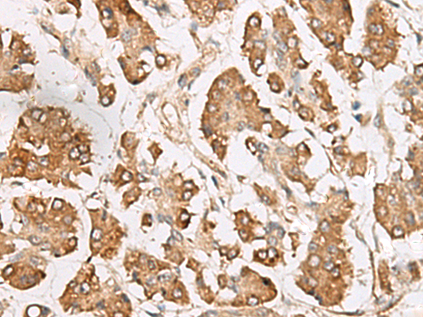 Immunohistochemistry of paraffin-embedded Human gastric cancer tissue  using SLC40A1 Polyclonal Antibody at dilution of 1:65(×200)
