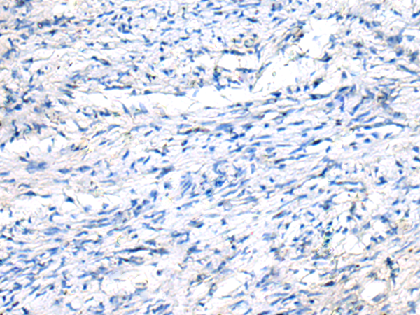 Immunohistochemistry of paraffin-embedded Human ovarian cancer tissue  using FGF11 Polyclonal Antibody at dilution of 1:50(×200)