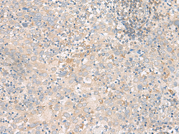 Immunohistochemistry of paraffin-embedded Human cervical cancer tissue  using FGF13 Polyclonal Antibody at dilution of 1:45(×200)