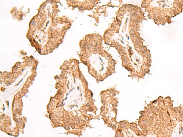 Immunohistochemistry of paraffin-embedded Human thyroid cancer tissue  using FGF13 Polyclonal Antibody at dilution of 1:45(×200)