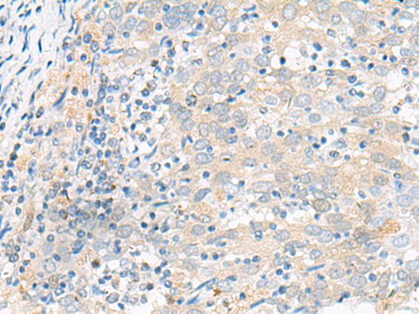 Immunohistochemistry of paraffin-embedded Human cervical cancer tissue  using FGR Polyclonal Antibody at dilution of 1:70(×200)