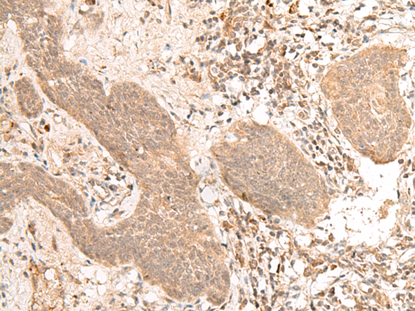 Immunohistochemistry of paraffin-embedded Human esophagus cancer tissue  using FIZ1 Polyclonal Antibody at dilution of 1:40(×200)