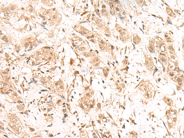 Immunohistochemistry of paraffin-embedded Human breast cancer tissue  using FIZ1 Polyclonal Antibody at dilution of 1:40(×200)