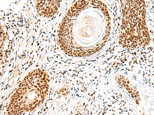 Immunohistochemistry of paraffin-embedded Human esophagus cancer tissue  using FKBP5 Polyclonal Antibody at dilution of 1:50(×200)