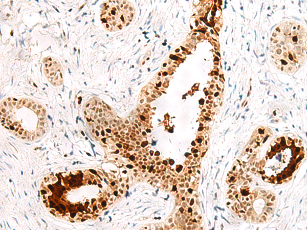 Immunohistochemistry of paraffin-embedded Human breast cancer tissue  using FKBP5 Polyclonal Antibody at dilution of 1:50(×200)