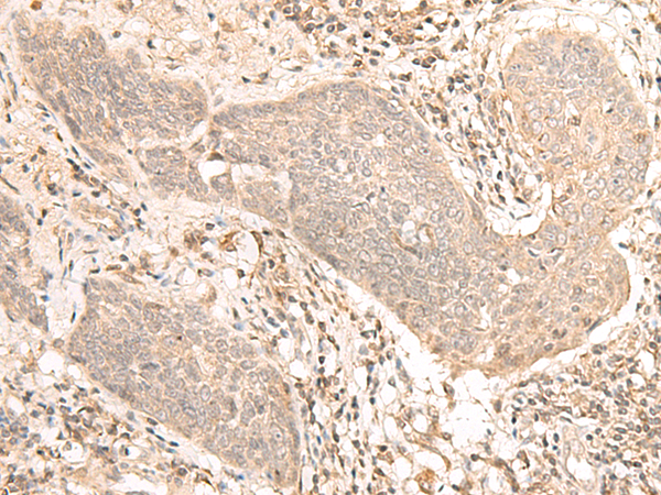 Immunohistochemistry of paraffin-embedded Human esophagus cancer tissue  using VPS50 Polyclonal Antibody at dilution of 1:30(×200)