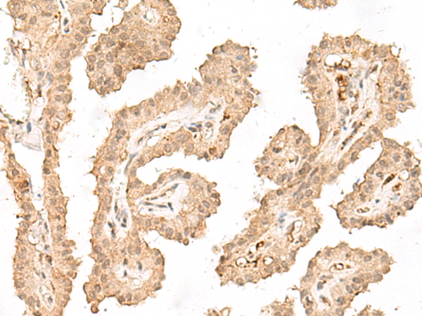 Immunohistochemistry of paraffin-embedded Human thyroid cancer tissue  using VPS50 Polyclonal Antibody at dilution of 1:30(×200)