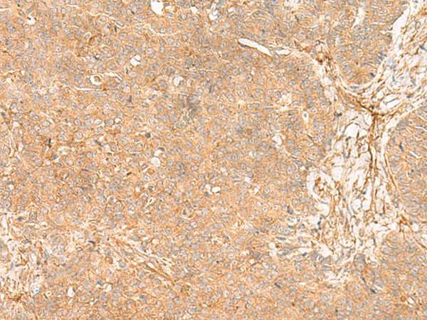 Immunohistochemistry of paraffin-embedded Human ovarian cancer tissue  using FLNC Polyclonal Antibody at dilution of 1:35(×200)