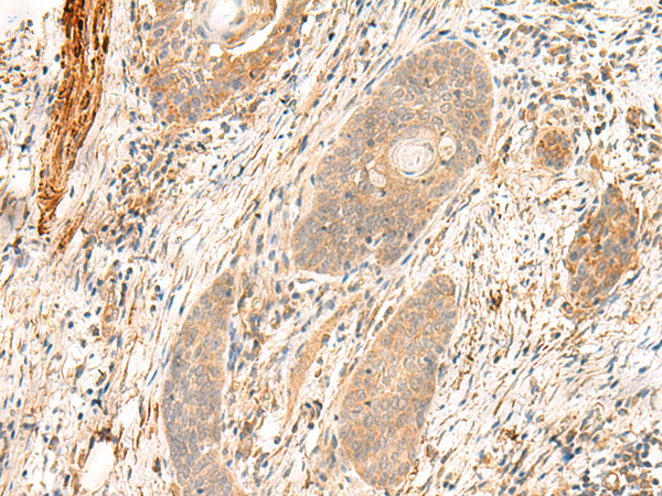 Immunohistochemistry of paraffin-embedded Human esophagus cancer tissue  using FLNC Polyclonal Antibody at dilution of 1:35(×200)