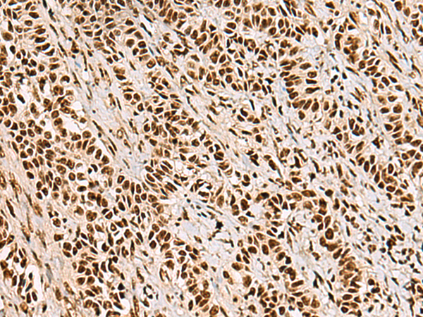 Immunohistochemistry of paraffin-embedded Human ovarian cancer tissue  using FOXI1 Polyclonal Antibody at dilution of 1:55(×200)